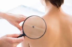 Verificarea Alunitelor Cabinet Dermatologic Dermavision