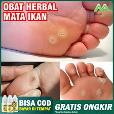 Setelah mengamalkan elken spirulina selama 3 bulan, saya mendapati ketuat semakin mengecil dan pada satu hari, ia hilang sepenuhnya. Larutan Mata Ikan Di Telapak Kaki Herbal Obat Mata Ikan Di Tumit Kaki Mata Ikan Di Jari Obat Penumpas Kapalan Obat Penghilang Kutil Menghilangkan Callus Dikaki Obat Alami Mata Ikan Di Tangan Propolis Sm 6ml Lazada