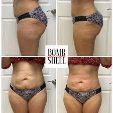 Bombshell Body Contour Body Contouring 25901 In 45 N Spring Tx Phone Number