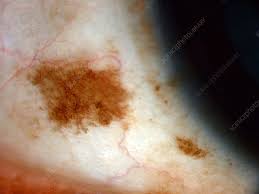 Image result for nevus sclerae