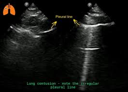 Image result for Pulmonary Contusion