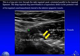 Www Tomwademd Net Ultrasound Imaging Of Hernia Parts 1 2 Of 4 A Youtube Video Ultrasound Medical Ultrasound Ultrasound Tech