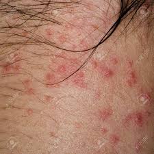 Image result for dermatitis contacta allergica