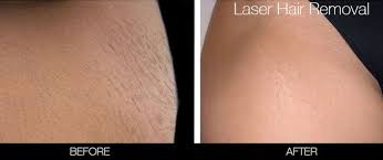 Brazilian Laser Hair Removal In Toronto Spamedica