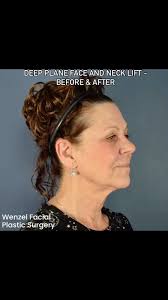 Deep Plane Facelift by Chris Wenzel, MD, double board certified Facial  Plastic Surgeon. Before surgery and one month after. Results may vary. Call  today for a consultation 828-550-3344. Offices in ...