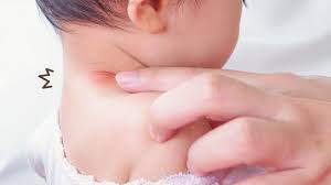Bisul akan muncul pada tubuh akibat infeksi bakteri dan ditandai dengan benjolan merah disertai bengkak. Bisulan Pada Bayi Ini Semua Hal Yang Perlu Moms Ketahui Orami