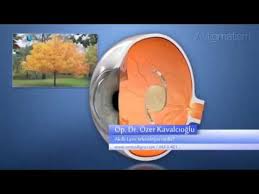 Akilli Lens Goz Ici Mercek Teknolojisi Nedir Youtube