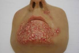 Image result for Tinnea vesiculosa