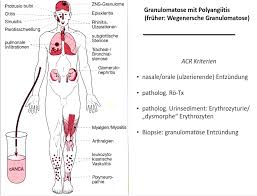 Rituximab Roche Bei Den Anca Assoziierten Vaskulitis Formen Gpa Und Mpa Zugelassen Rheuma Online