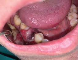 Oral Metastasis From Colorectal Adenocarcinoma: Report of a New Case and a  Scoping Review - Gioco - 2025 - Case Reports in Dentistry - Wiley Online  Library