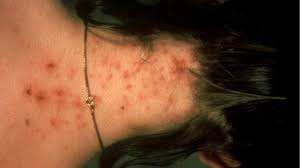 Image result for sores on the head in children