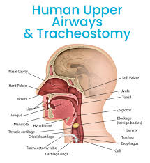 Image result for Tracheostomy