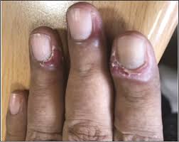 Image result for paronychium