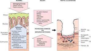 Chronic Gastritis Peptic Ulcer Maybe Visualizing This Will Persuade Me To Go To The Doctor Instead Of Toughing It Out Peptic Ulcer Ulcers Chronic