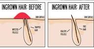Ingrown Hair Infection