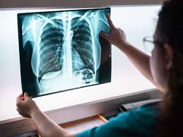 In fact, there are more than three million cases in the united states every year. Lung Cancer Pictures Ct Scan X Ray And More