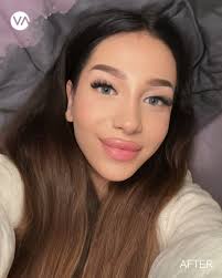 Have you seen this stunning rhinoplasty transformation? 👃✨ She got the  look she always dreamed of at Vanity Cosmetic Surgery Hospital bold,  refined, and totally her! What do you think about her