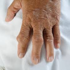 Image result for gout
