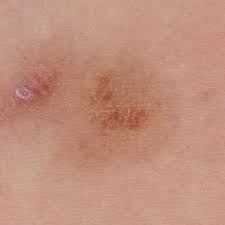 To treat purpura, doctors must determine its cause. Why Do I Get Purpura After Itching Quora