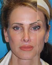 The results speak for themselves!, This beautiful outcome was achieved with  a deep plane facelift, submandibular gland contouring, temple browlift, and  an upper lip lift—designed to restore youthful ...