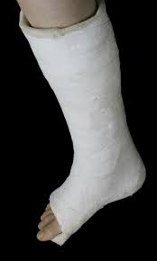 Image result for Foot Fracture