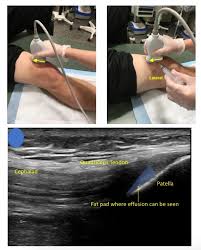 Image result for Septic Joint
