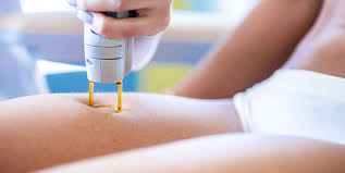 The convenience of being able to carry out treatments at home is also an advantage. The Best At Home Laser Hair Removal Devices And How To Use Them