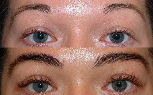 eye brow transplantation product image
