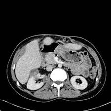 Image result for Perinephric Abscess