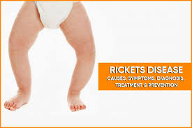 Image result for Rickets