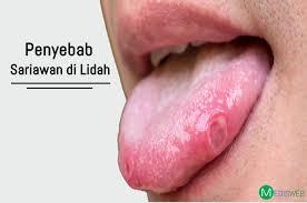 We did not find results for: Ketahui Penyebab Sariawan Di Lidah Dan Cara Mengobatinya Medisweb