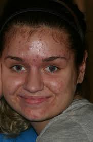 Aug 27, 2017 · thinking person would put someone on accutane without blood tests to check liver function. Let S Talk Acne My Skincare Routine On Accutane Mid Treatment Thoughts My Results So Far Thirteen Thoughts