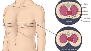 Consult a doctor for medical advice. What Is Pectus Excavatum