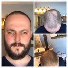 Buzzed It Down No 2 On Top 1 1 5 Fade On The Sides Before Pic Link In Comments What Do You Think Bald