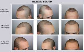 Androgens are also one of those hormones that support scalp hair growth to a limited extent. Fue Hair Transplant Technique