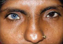 Waardenburg Syndrome A Report Of Three Cases Indian Journal Of Dermatology Venereology And Leprology