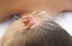 Acupuncture And Herbs Eliminate Meniere S Disease