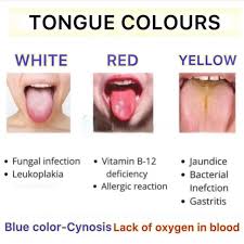 Image result for yellow tongue infection