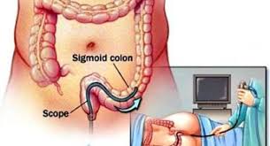 Image result for Continuous Bladder Irrigation