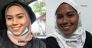Sunburn selalu terjadi apabila kulit muka terdedah lama kepada cahaya matahari. Pakai Sunscreen Pun Kulit Wajah Teruk Sunburn Tak Tahu Apa Penyebab Gadis Ini Kongsi Pengalaman Hijabista