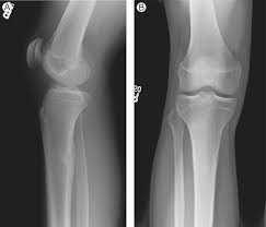 Image result for Tibia Stress Fracture
