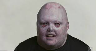 People with facial disfigurement share experience of prejudice