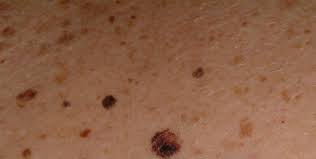Almost all basal and squamous cell cancers and the vast majority of melan. Skin Checks Four Reasons To Get Your Skin Checked Early And Regularly