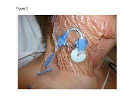 Central catheters provide dependable intravenous access and enable hemodynamic monitoring and blood sampling. Illustration Of Central Venous Catheter Insertion Site Care And Cover Download Scientific Diagram