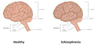 How schizophrenia affects the brain. Schizophrenic Or Schizophrenia Brain Vs Normal Brain