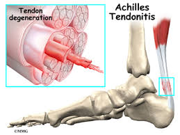 Alibaba.com offers 1,111 tendons in the leg products. Patient Education Concord Orthopaedics