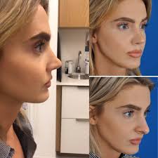 Rhinoplasty Before After Video Rhinoplasty Before And After Nonsurgical Nose Job Rhinoplasty