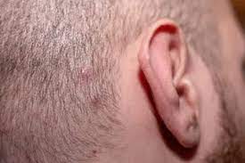 An ingrown hair may also become infected most ingrown hairs on the legs do not cause complications, and they usually resolve on their own. How To Treat Ingrown Hair On Scalp Easy Care Tips Bald Beards
