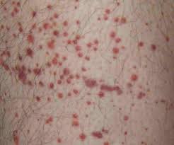 It most commonly occurs in children. Purpura Types Causes Diagnosis And Treatment