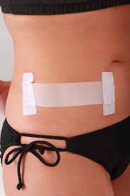 I loook forward to hearing from you. Appendectomy Scar Open Appendectomy Laparoscopic